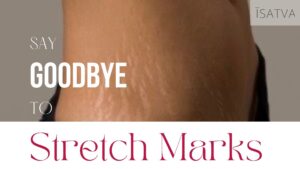 featured image - say goodbye to stretch marks